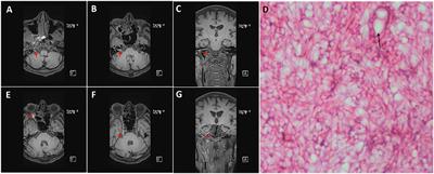 Acute invasive mucormycosis rhinosinusitis causing multigroup cranial nerve injury and meningitis—A case report